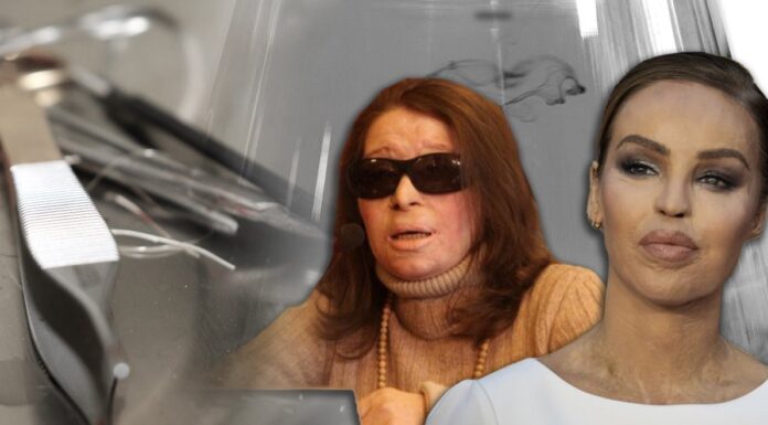 Επιθέσεις με βιτριόλι: Από την Ελλάδα στο σκληρό νόμο του Πακιστάν Το βιτριόλι οπλο στα χέρια απατημένων