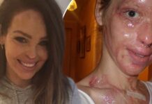 Η επίθεση με οξύ στην 24χρονη Katie Piper: Τα 40 χειρουργεία & το θαύμα της αποκατάστασης (βίντεο) επίθεση με οξύ στην 24χρονη Katie Piper