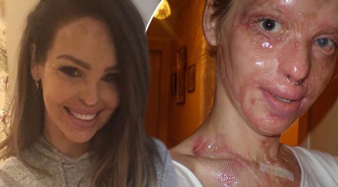 Η επίθεση με οξύ στην 24χρονη Katie Piper: Τα 40 χειρουργεία & το θαύμα της αποκατάστασης (βίντεο) επίθεση με οξύ στην 24χρονη Katie Piper
