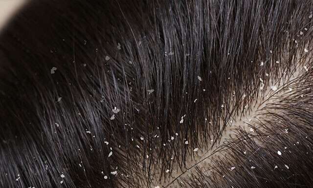 Λύσεις πιτυρίδας και οικιακές θεραπείες Λύσεις πιτυρίδας και οικιακές θεραπείες